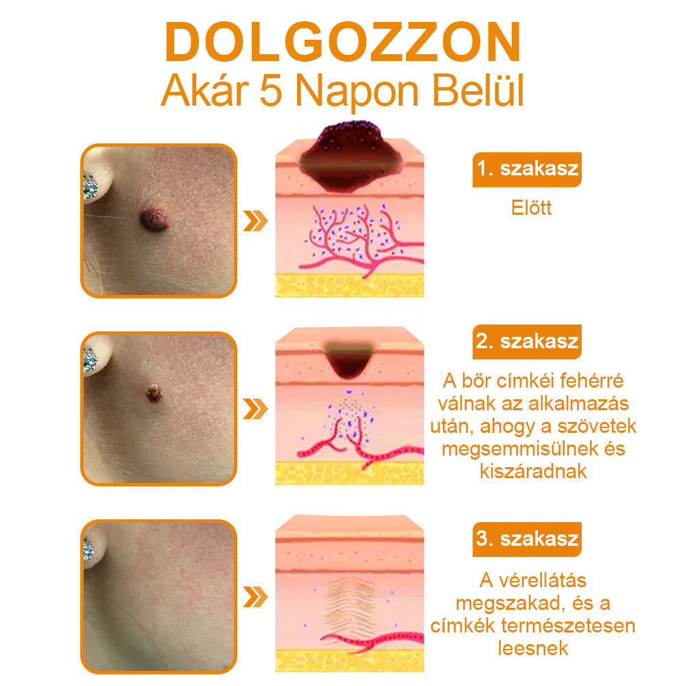 Creme para remoção de verrugas e verrugas com veneno de abelha Vsoxa™ (venda no último dia, 80% de desconto)
