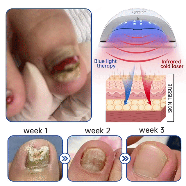 Dispositivo de tratamento laser Furzero™ PureNail para fungos
