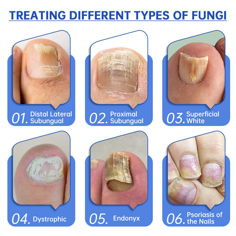 Dispositivo de tratamento laser Furzero™ PureNail para fungos