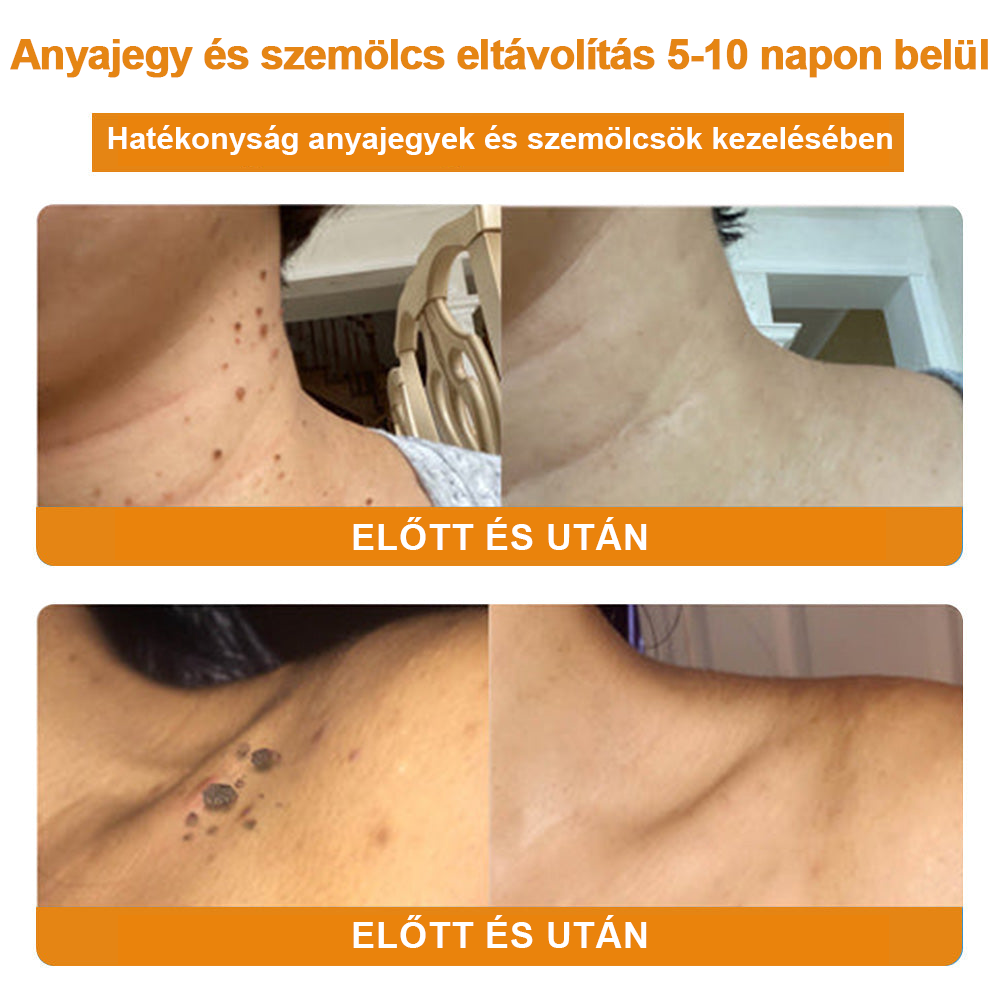 Creme para remoção de verrugas e verrugas com veneno de abelha Vsoxa™ (venda no último dia, 80% de desconto)